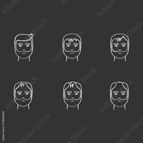 Hair loss chalk white icons set on black background. Baldness process stages. Male alopecia conditions. Dermatology problem with scalp. Aging and stress. Isolated vector chalkboard illustrations