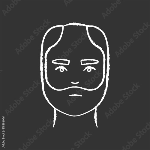 Male hair chalk white icon on black background. Man with alopecia. Hairloss problem. Baldness spot. Dermatology and haircare treatment. Thinning hairline. Isolated vector chalkboard illustration