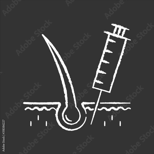 Hairloss injection chalk white icon on black background. Professional alopecia treatment. Medical therapy for baldness problem. Haircare and dermatology. Isolated vector chalkboard illustration