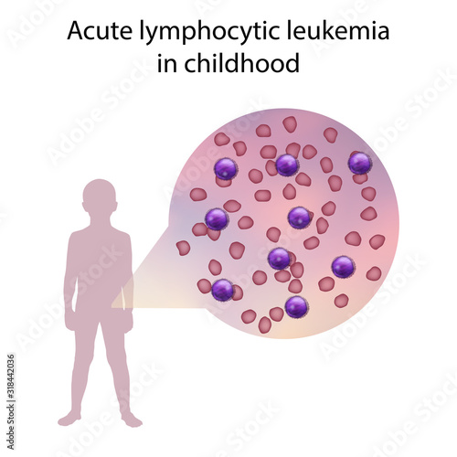 Acute lymphocytic leukemia in childhood. Immature lymphocytes. Medical anatomy illustration.