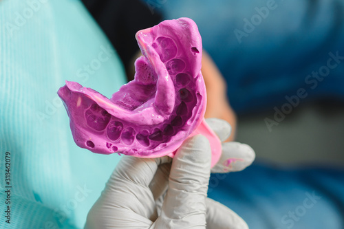 Obraz na plátně Doctor orthodontist in gloves holds a fingerprint for denture purple
