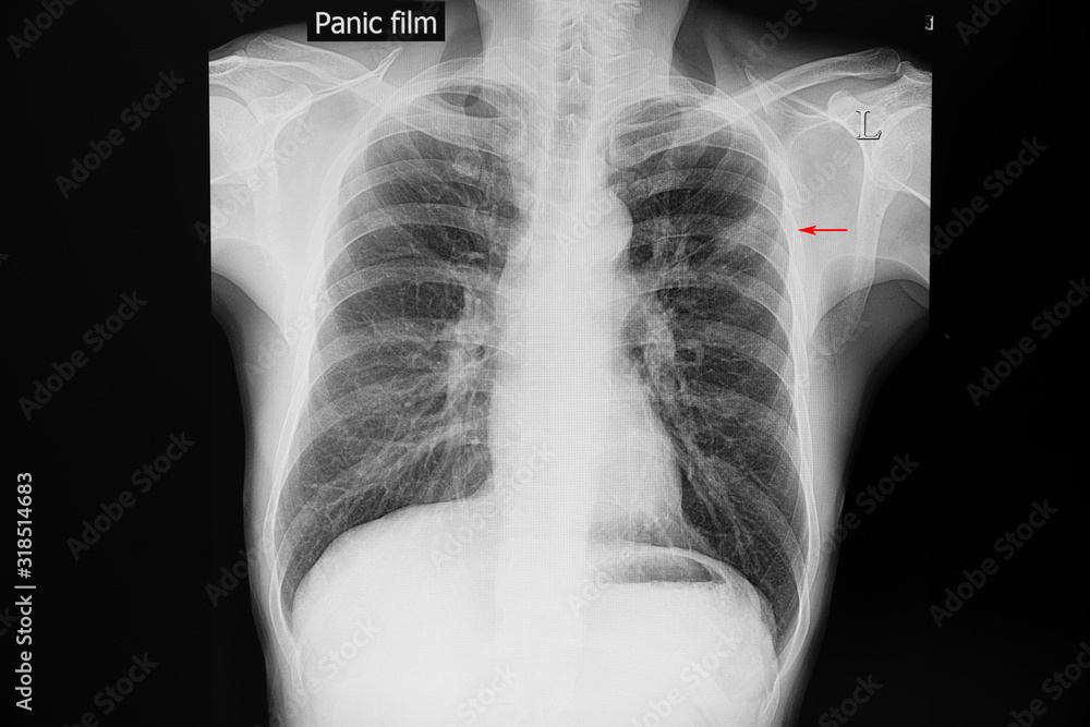 Chest Xray film of a patient with tuberculosis Chest Xray film of a patient with tuberculosis