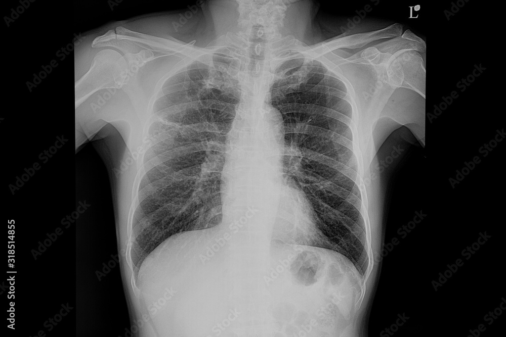 Chest xray film of a patient with pneumonia Chest xray film of a patient with pneumonia
