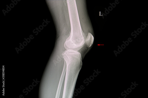 x ray film of a patient with fractured patella