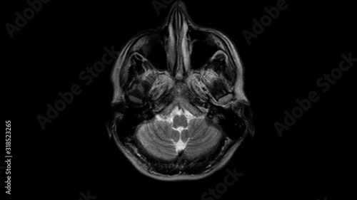 Brain MRI, head scans and tumor detection. Diagnostic medical tool