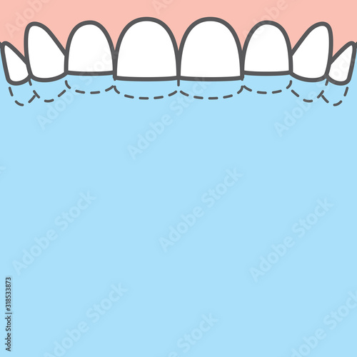 Blank banner Upper attrition (Bruxism) teeth illustration vector on blue background. Dental concept.