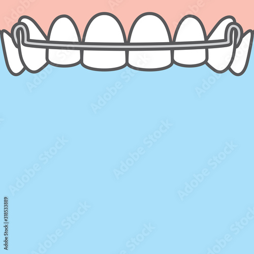 Blank banner Upper Hawley retainer illustration vector on blue background. Dental concept.