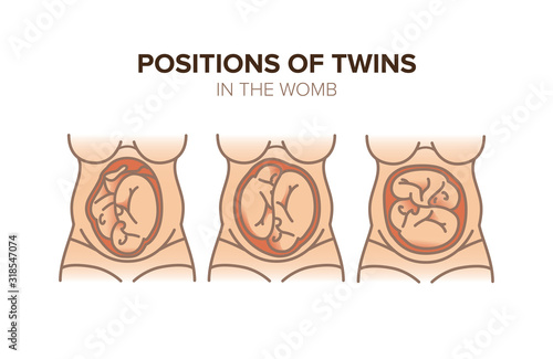 Position of twins in the womb. Pregnancy