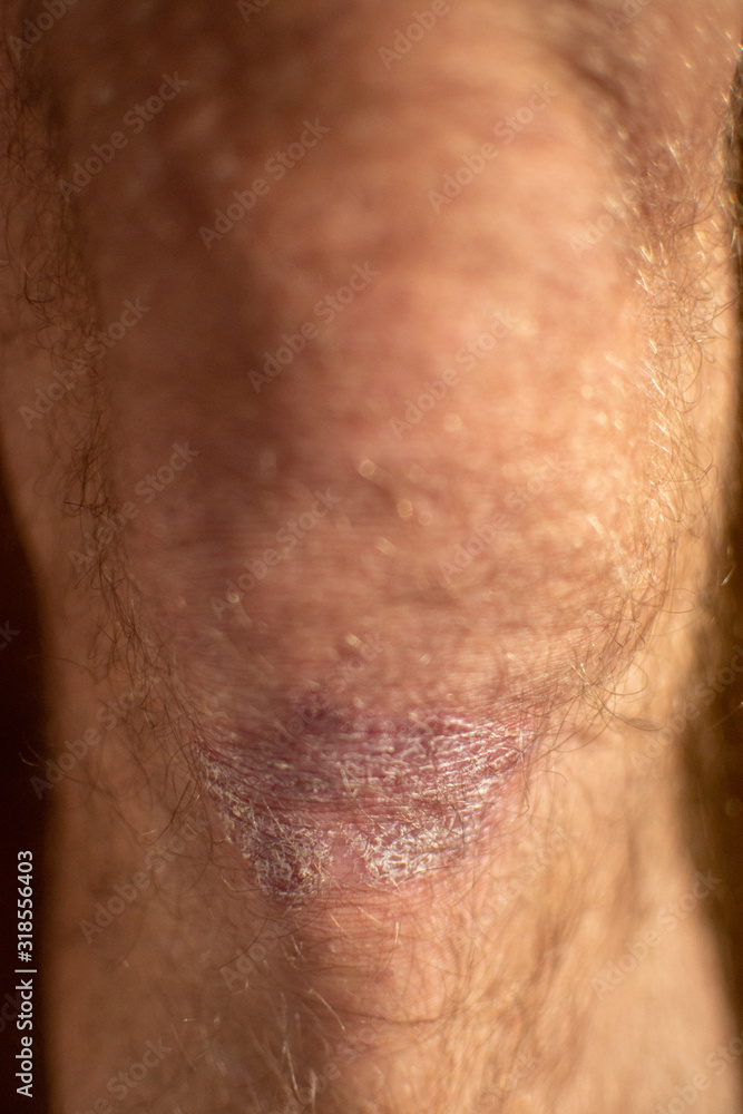 Naklejka premium Skin disease - psoriasis on the knee