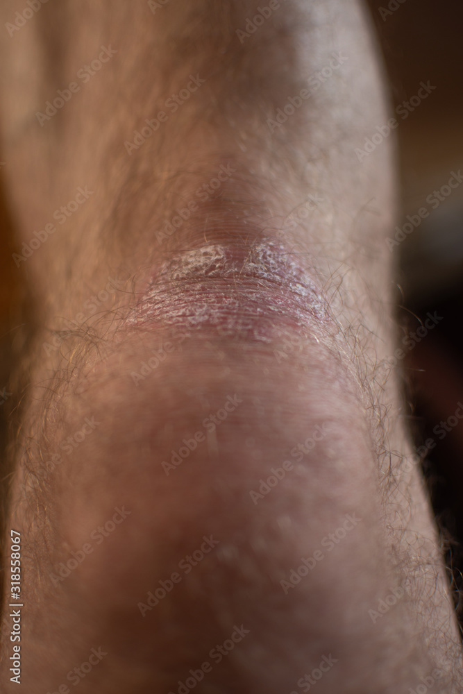 Fototapeta premium Skin disease - psoriasis on the knee