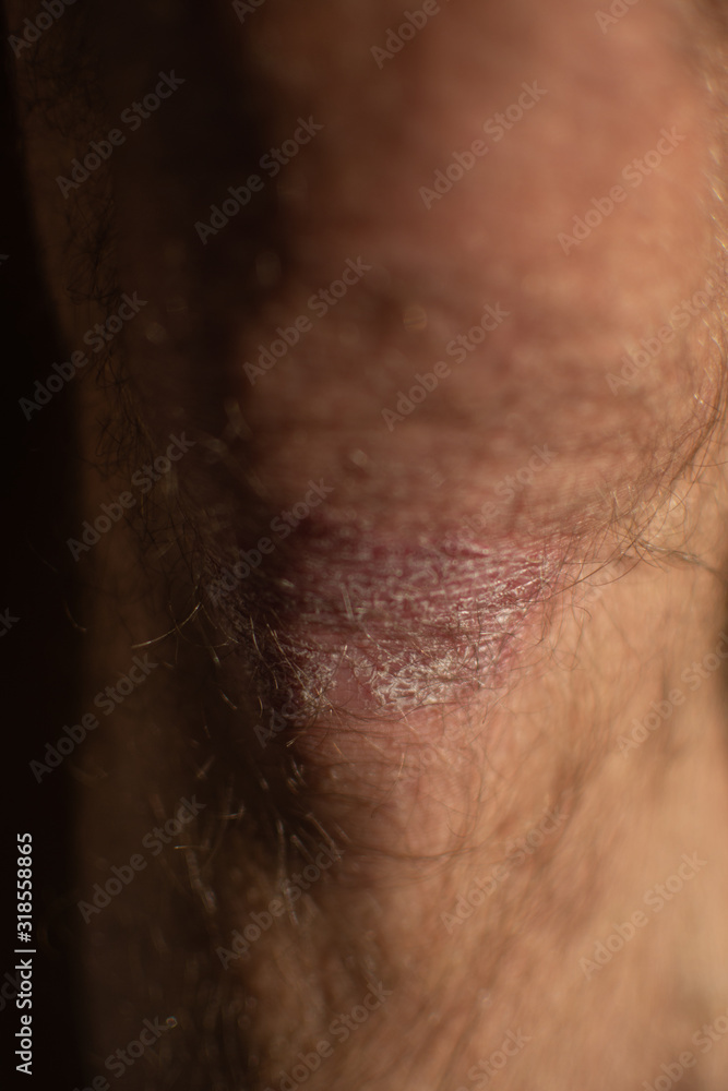 Skin disease - psoriasis on the knee
