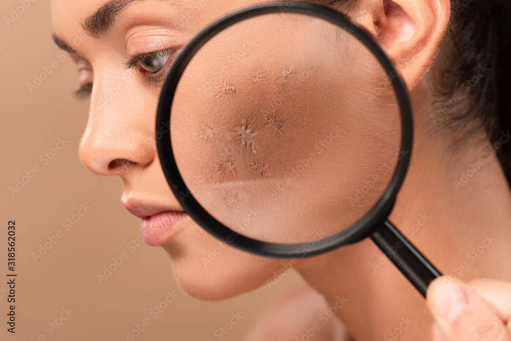 cropped view of man holding magnifying glass near young woman with problem skin isolated on beige cropped view of man holding magnifying glass near young woman with problem skin isolated on beige