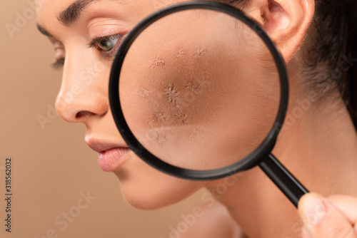cropped view of man holding magnifying glass near young woman with problem skin isolated on beige