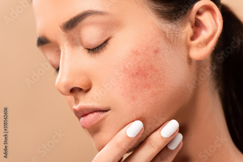 young woman with closed eyes touching face with acne isolated on beige photo