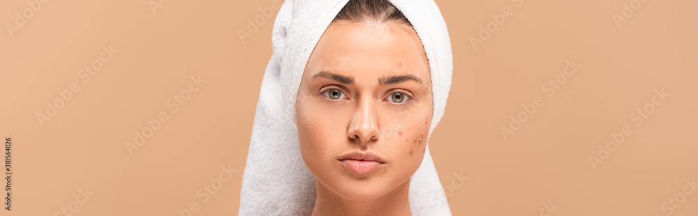 panoramic shot of woman in towel with acne on face isolated on beige panoramic shot of woman in towel with acne on face isolated on beige