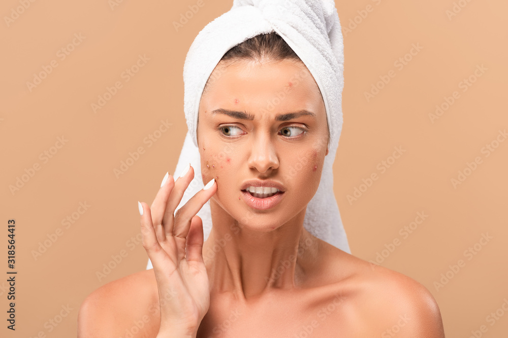 upset nude girl in towel touching acne on face isolated on beige Stock