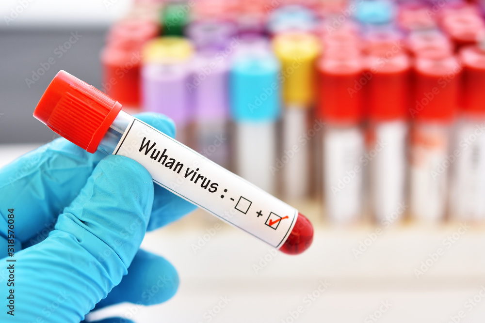Obraz premium Blood sample tube positive with Wuhan virus, novel coronavirus 2019 found in Wuhan, China