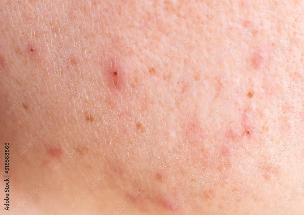 Red acne on the girl's face, background, macro