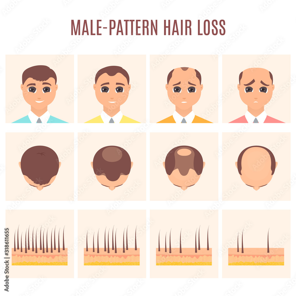 Male Pattern Hair Loss Set Stages Of Baldness In Men Treatment Result