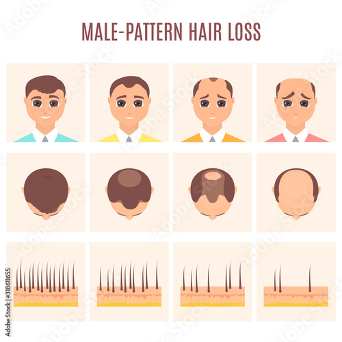 Male pattern hair loss set. Stages of baldness in men. Treatment result in front and top view. Number of follicles on scalp in each step. Alopecia infographic medical vector illustration.