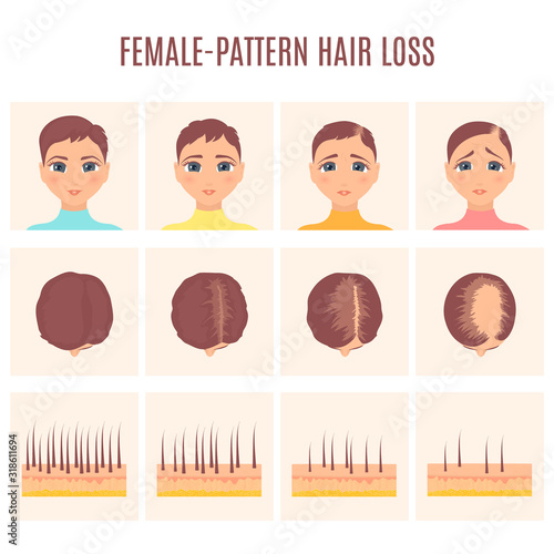 Female pattern hair loss set. Stages of baldness in women. Treatment result in front and top view. Number of follicles on scalp in each step. Alopecia infographic medical vector illustration.