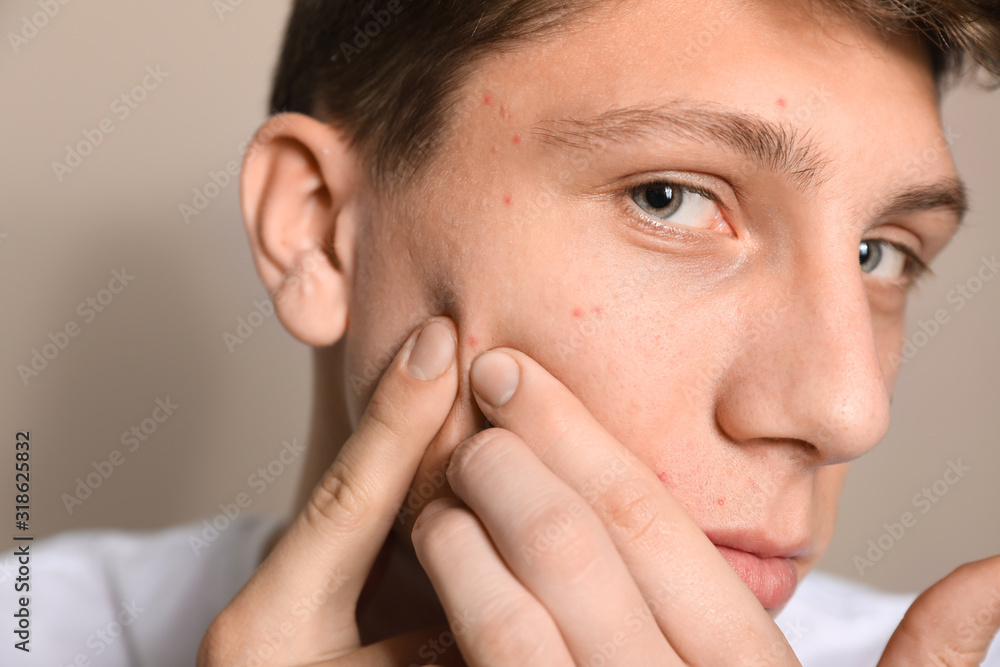 Teen guy with acne problem squeezing pimple on beige background, closeup Teen guy with acne problem squeezing pimple on beige background, closeup
