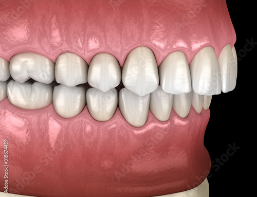 Overbite dental occlusion ( Malocclusion of teeth ). Medically accurate tooth 3D illustration