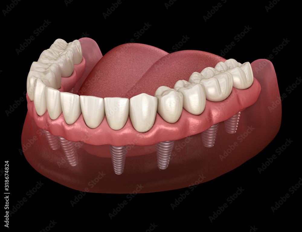 Obraz premium Mandibular prosthesis All on 8 system supported by implants. Medically accurate 3D illustration of human teeth and dentures concept