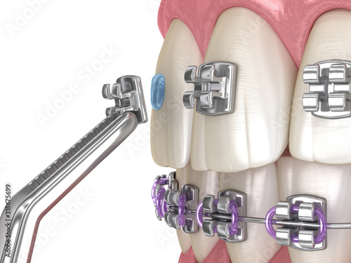 Metal braces installation process. Medically accurate dental 3D illustration