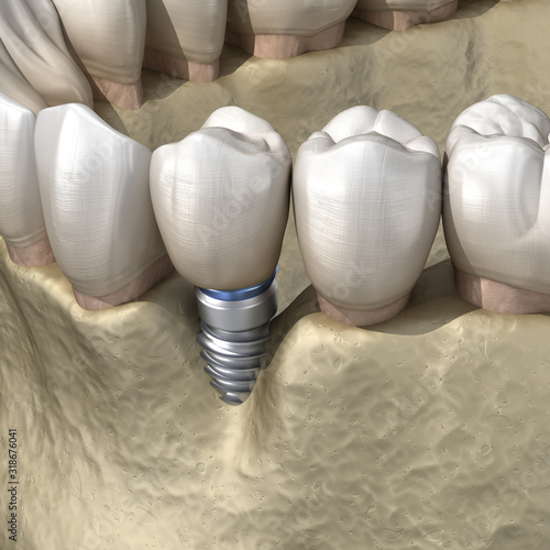 Periimplantitis with visible bone reduction. Medically accurate 3D illustration of dental implants concept photo