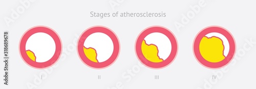 Atherosclerosis stages in artery caused by cholesterol plaque
