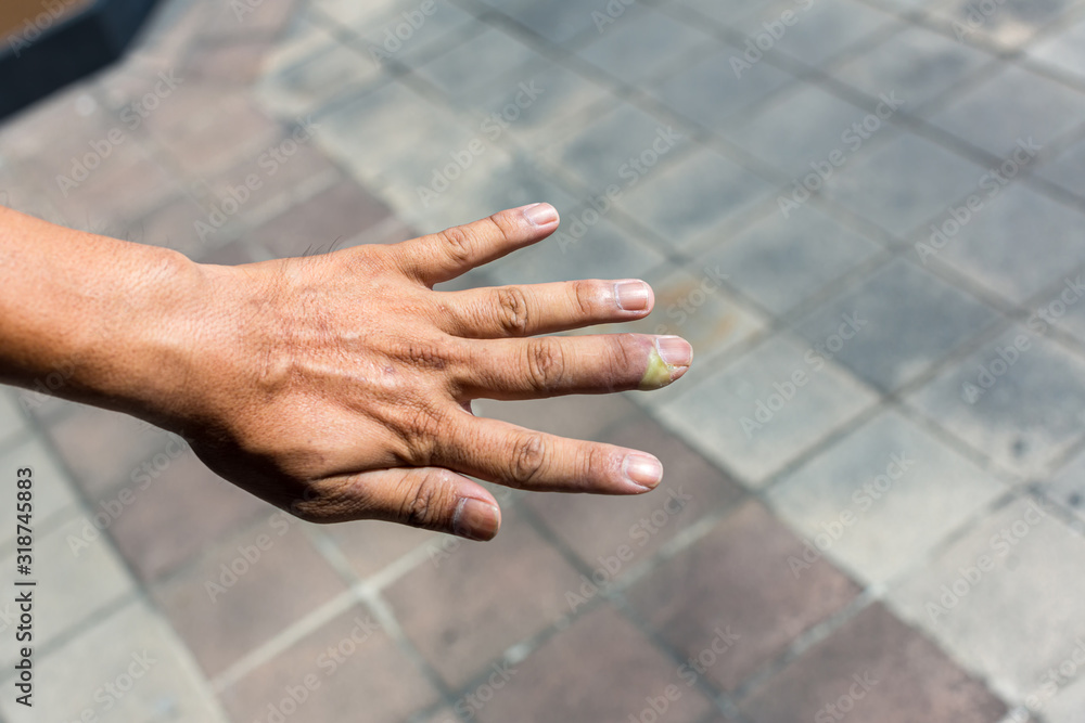 Paronychia, swollen finger with fingernail bed inflammation due to bacterial infection on a