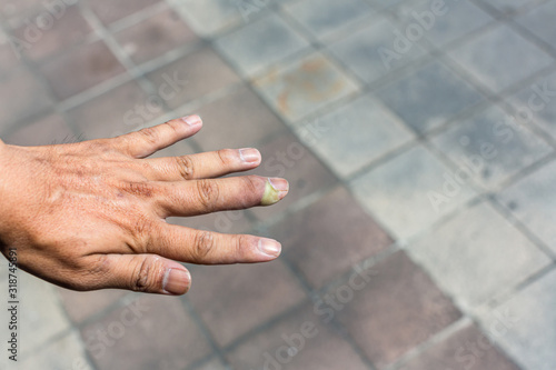 Paronychia, swollen finger with fingernail bed inflammation due to bacterial infection on a toddlers hand. finger swollen with inflammation due to Nail ripped infection. photo