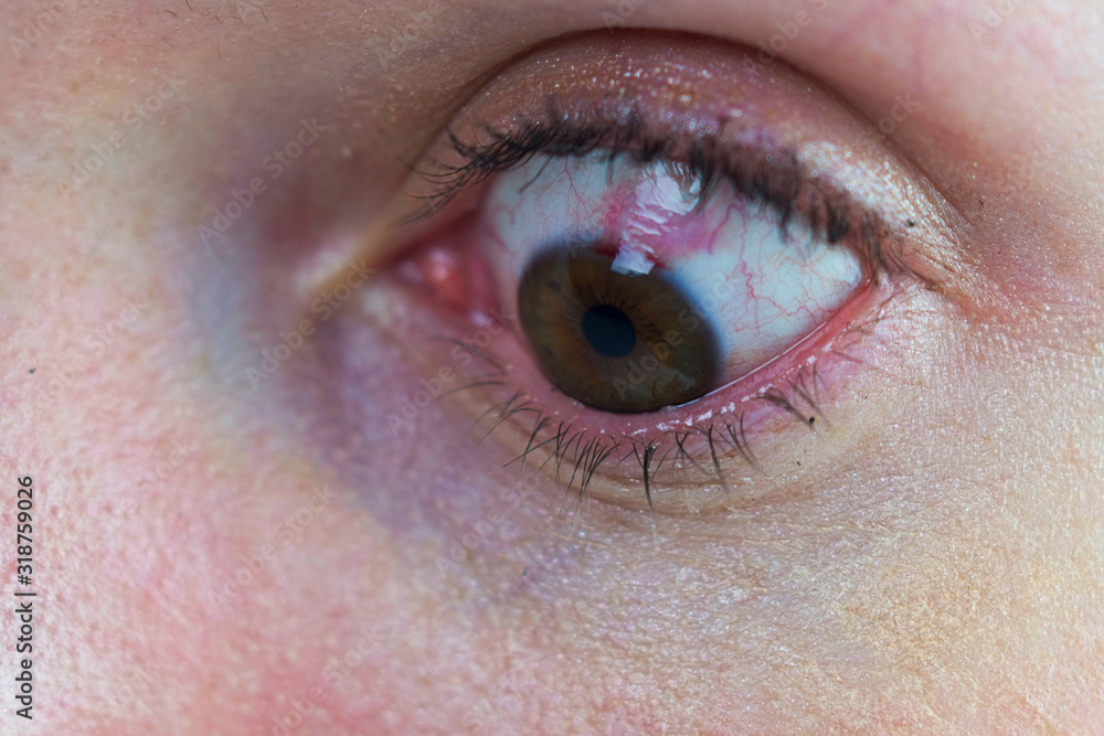 Obraz premium Eye with bloody sclera from laser eye surgery damage. Blood cells in eye, visiblely bloodshot. Makeup wearing female