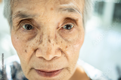 Exhausted asian senior woman suffering from insomnia,.chronic insomnia or allergies causing her sunken eye, dark circles, blear eyed,female elderly feeling tired,fatigued, not get a wink of sleep