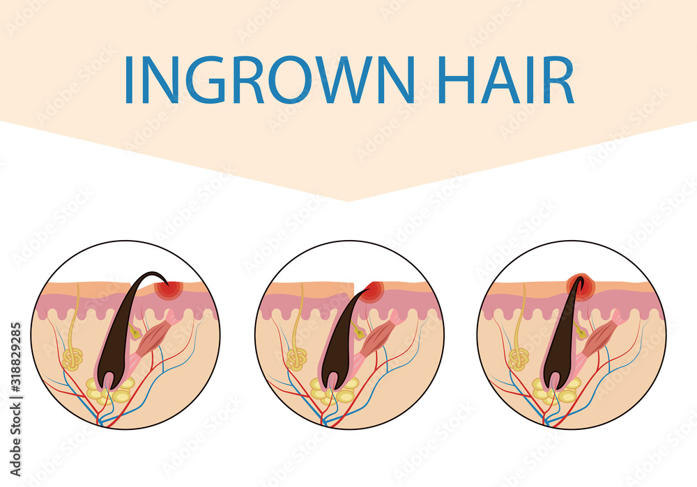 Varieties of ingrown hair. Medical scheme of hair ingrowth. Vector ...