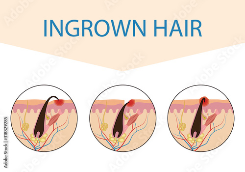 Varieties of ingrown hair. Medical scheme of hair ingrowth. Vector illustration isolated on white background for design and Internet.