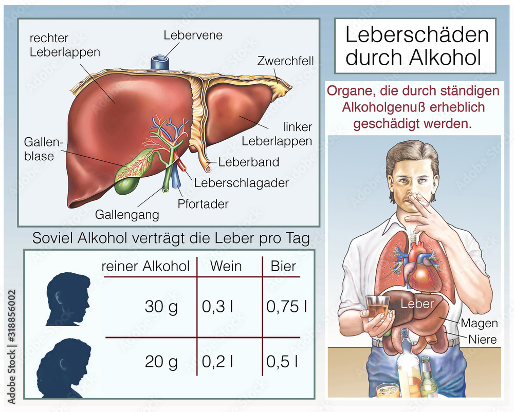 Alkoholvergiftung.Leberschaden.Alkohol schädigt die Organe Stock Illustration Adobe Stock