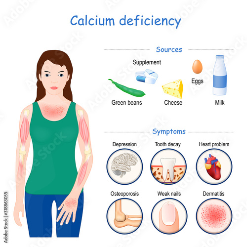calcium deficiency. Sign, symptoms, and Sources photo