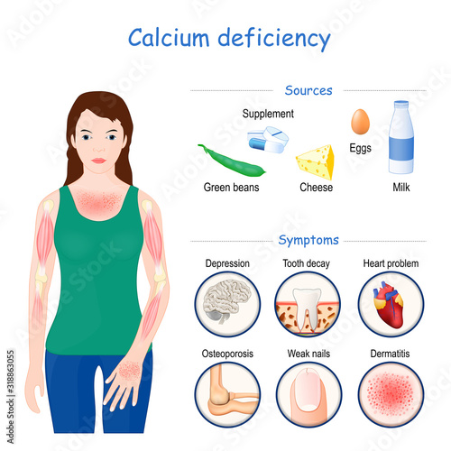calcium deficiency. Sign, symptoms, and Sources
