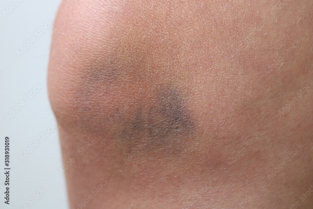 bruises on the woman's knee on white background close up bruises on the woman's knee on white background close up