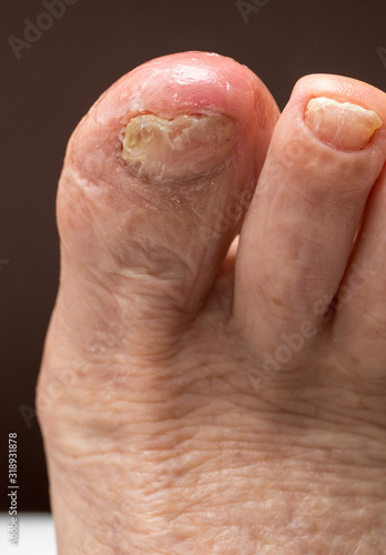 Big toe infected with fungus and an ingrown nail © Marcos
