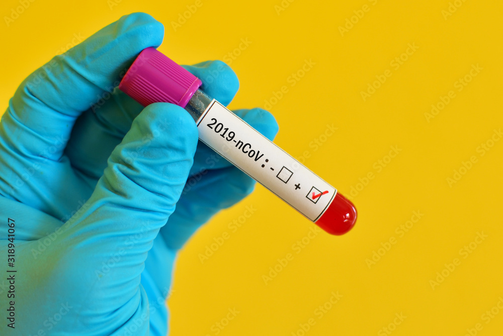 Obraz premium Blood sample tube positive with coronavirus 2019 or 2019-nCoV, novel coronavirus found in Wuhan, China