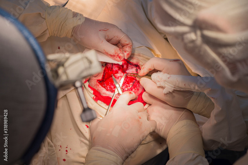 top view, stages of neurosurgical surgery for installing a titanium plate in the patients skull. Pediatric neurosurgery. Craniotomy