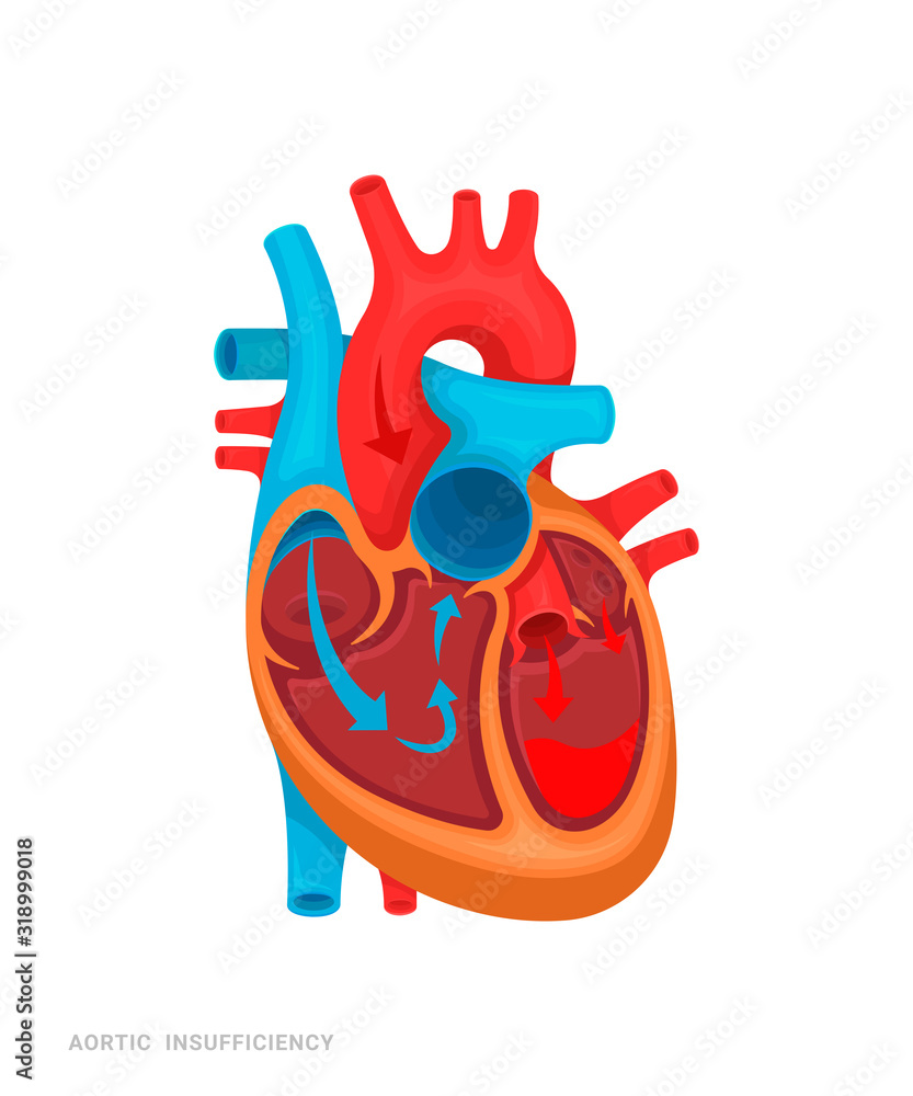 Heart defect. Aortic insufficiency. Illustration for medicine books, websites, apps. Heart disease with name. Heart defect. Aortic insufficiency. Illustration for medicine books, websites, apps. Heart disease with name.