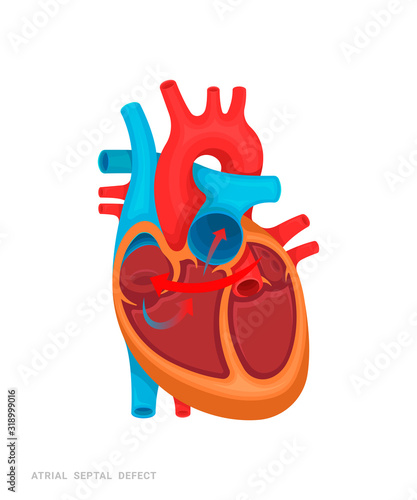 Heart defect. Atrial septal defect. Illustration for medicine books, websites, apps. Heart disease with name.