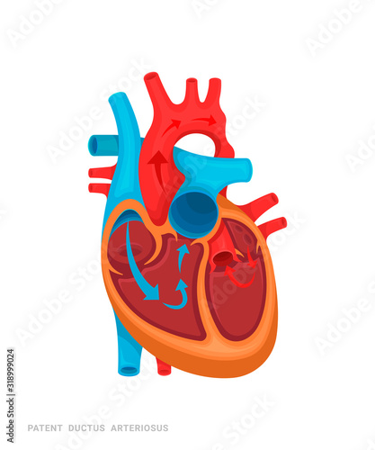Heart defect. Patent ductus arteriosus. Illustration for medicine books, websites, apps. Heart disease with name.
