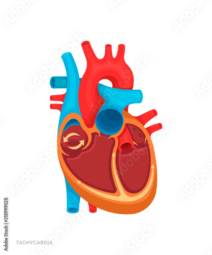 Heart defect. Tachycardia. Illustration for medicine books, websites, apps. Heart disease with name.