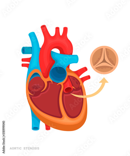 Heart defect. Aortic stenosis. Illustration for medicine books, websites, apps. Heart disease with name.