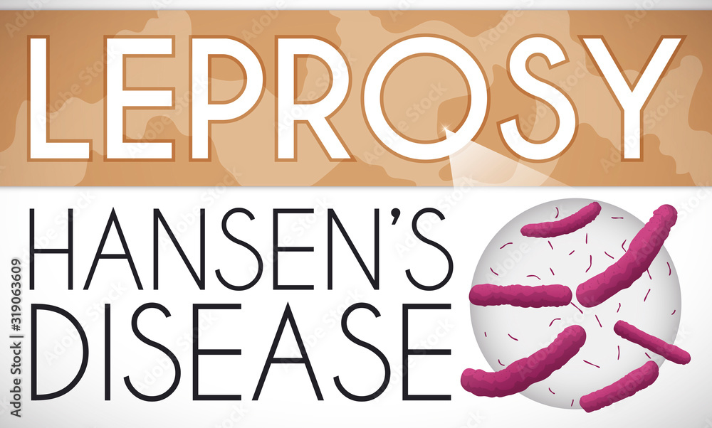 Hansen Images Skin Patches and Enlarged Sample due Hansen's Disease or Leprosy ...